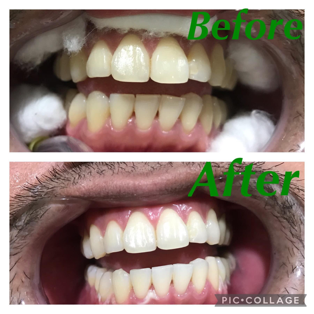 Laser whitening