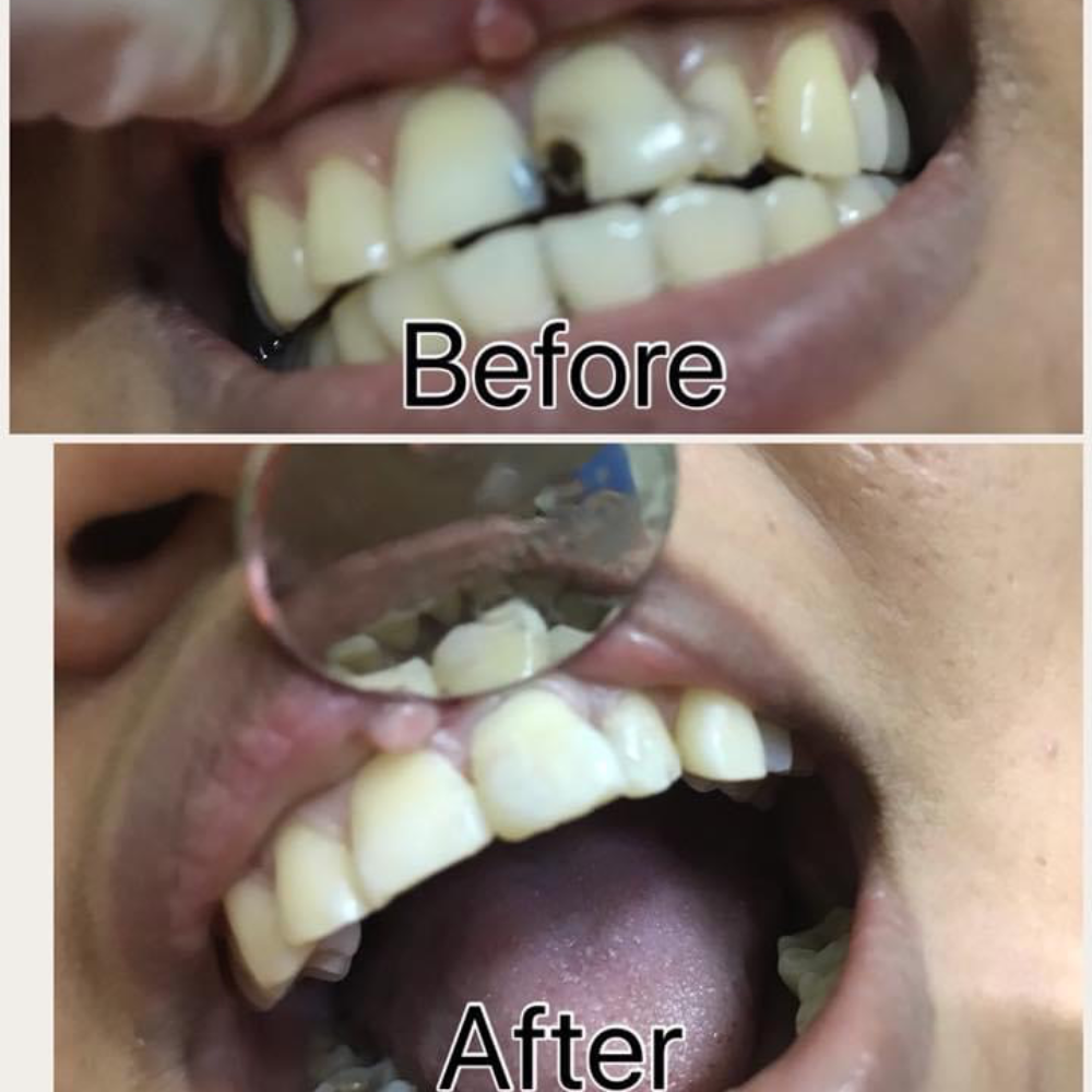 Composite filling