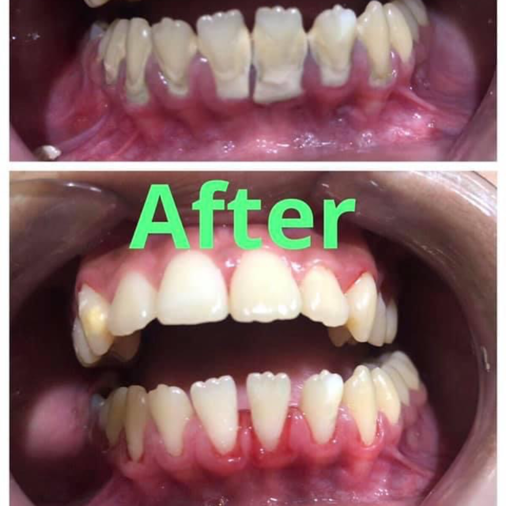 Oral prophylaxis