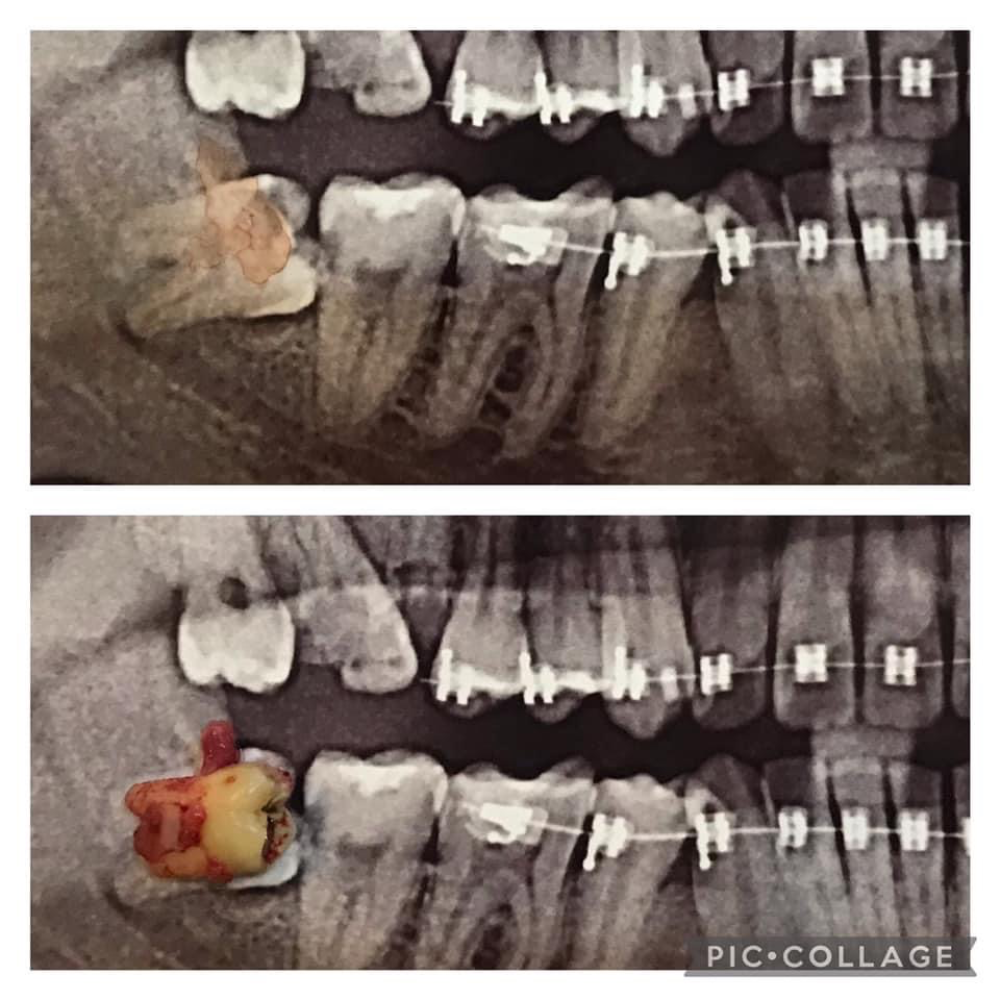 Odontectomy