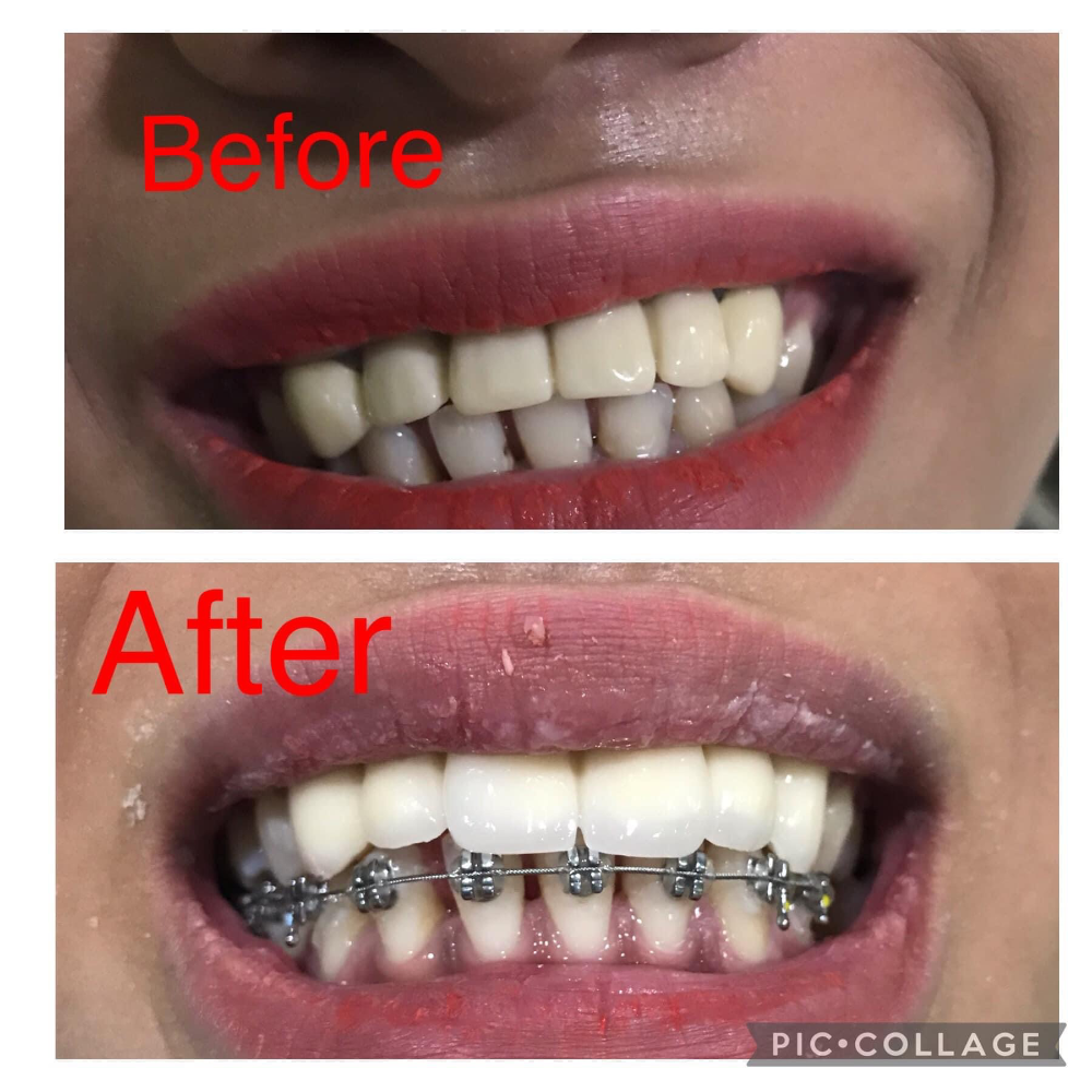 Zirconia crowns