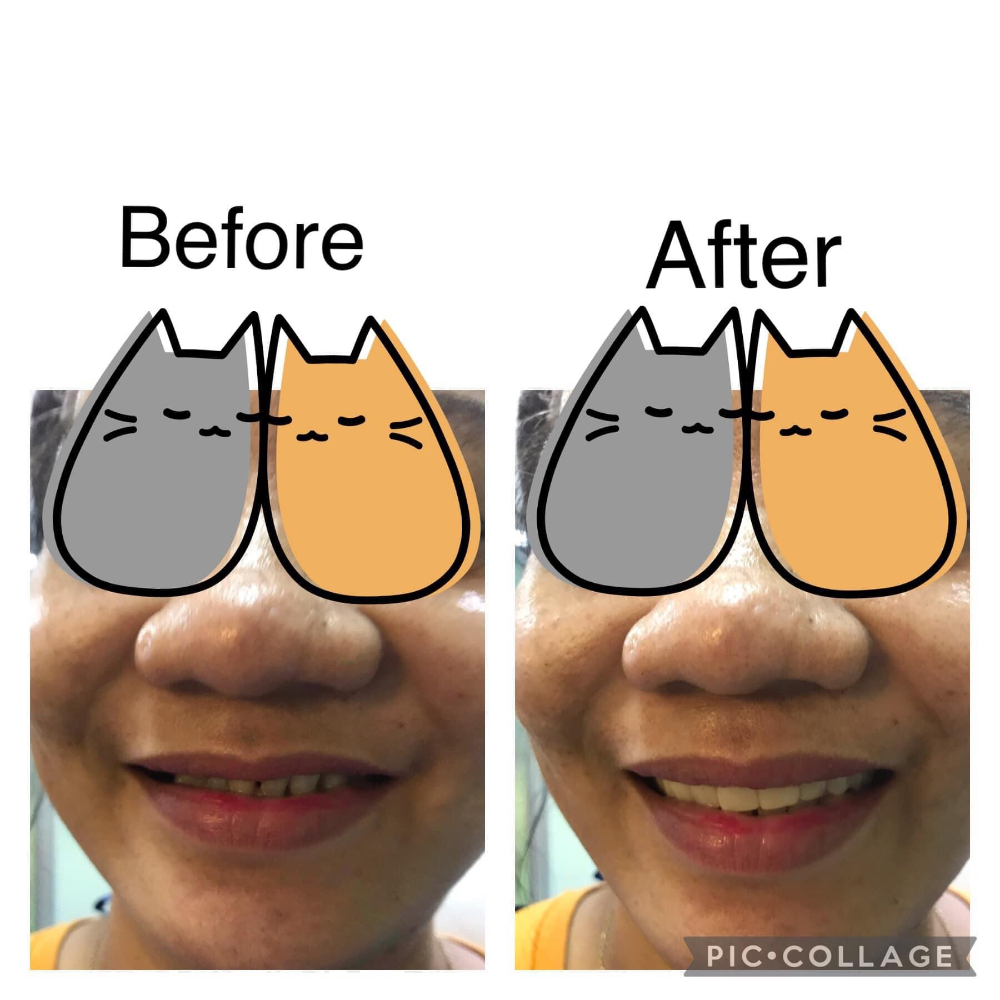 Removable dentures