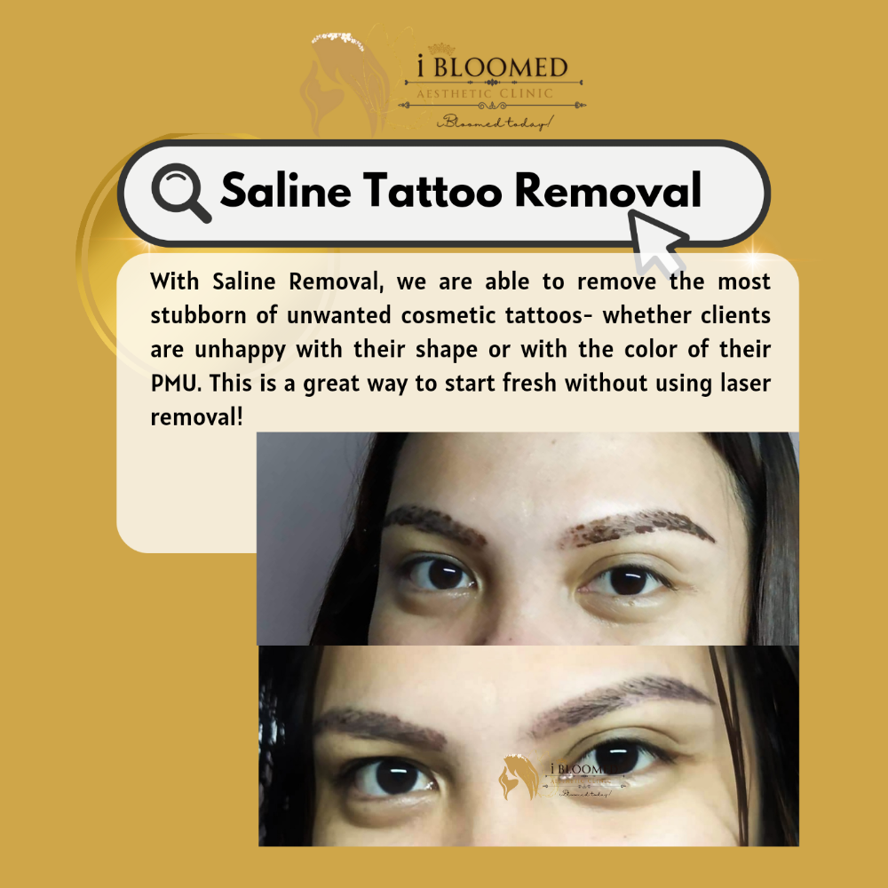 SALINE TATOO REMOVAL