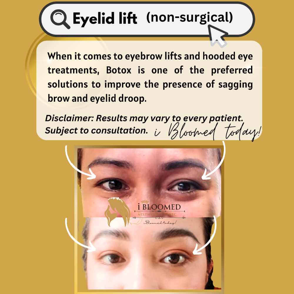 Eyelid lift (non-surgical)