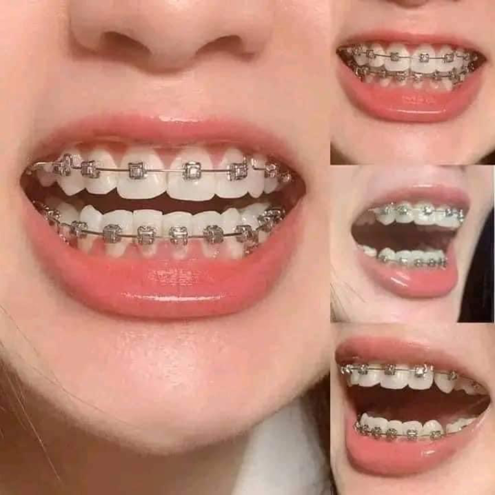 Silver Normal Design Ready to wear Braces